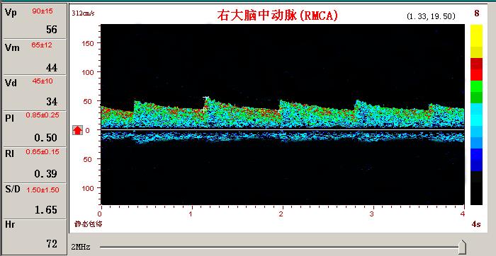 超聲經(jīng)顱多普勒腦血管擴張頻譜圖.jpg