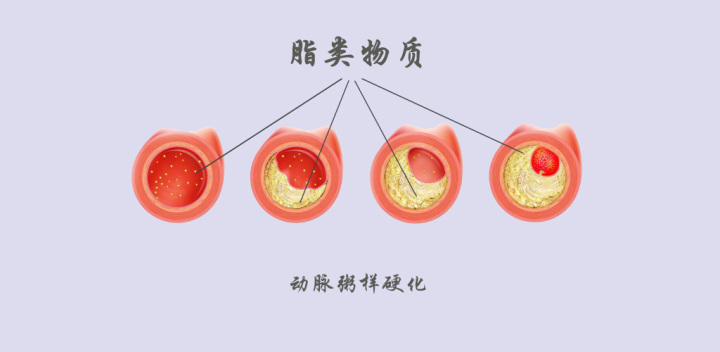 顱內(nèi)動脈粥樣硬化與缺血性腦卒中的關系